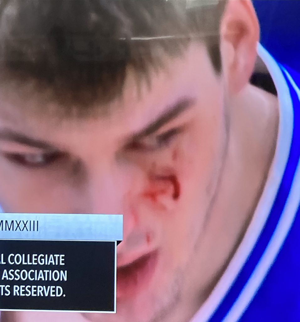 Kyle F. face bleeding